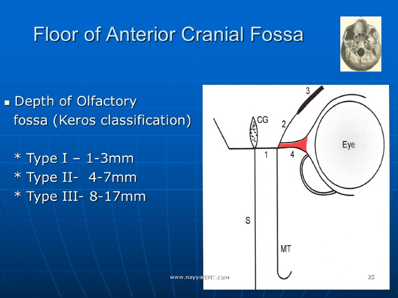 Floor of Anterior Cranial Fossa  Depth of Olfactory   fossa (Keros classification)